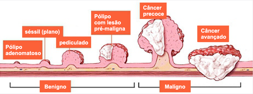 Câncer Colo Retal