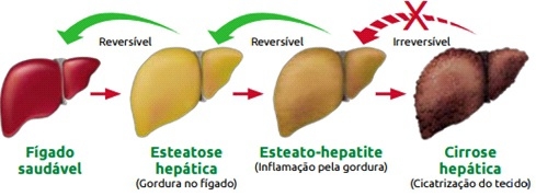 Esteatose hepática