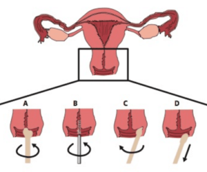 cervico vaginal